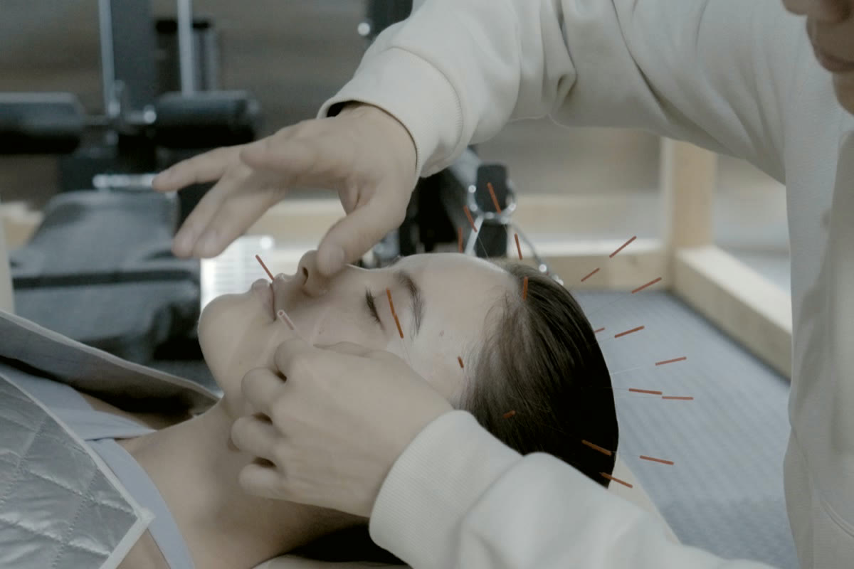 Acupuncture